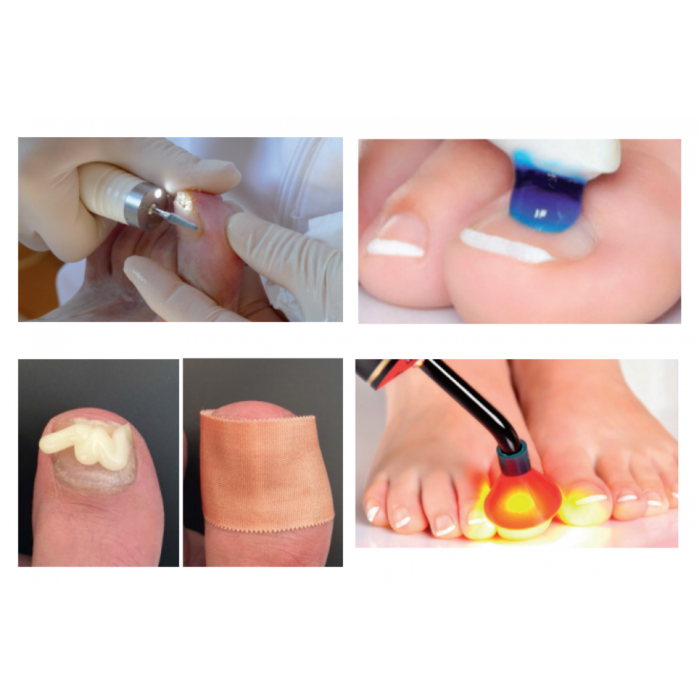 PACT Med Photodynamic Nail Fungus Therapy Kit PACTmed Nail Fungus